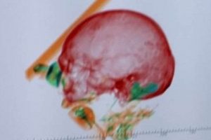 Read more about the article მიუნხენის აეროპორტში სომეხი ქალი დააკავეს, რომელსაც ბარგში ქმრის ძვლები ჰქონდა